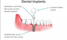Infographic showing how dental implants work