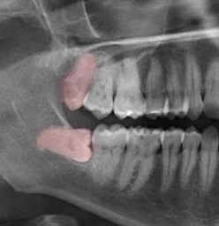 Wisdom Teeth Removal Toronto City Dental